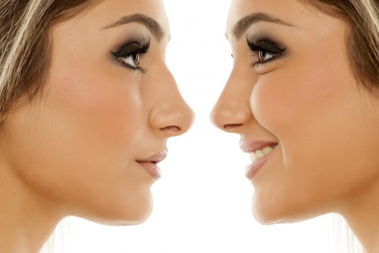 Expectation After Rhinoplasty